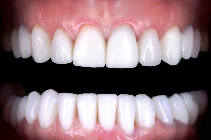 after dental procedure