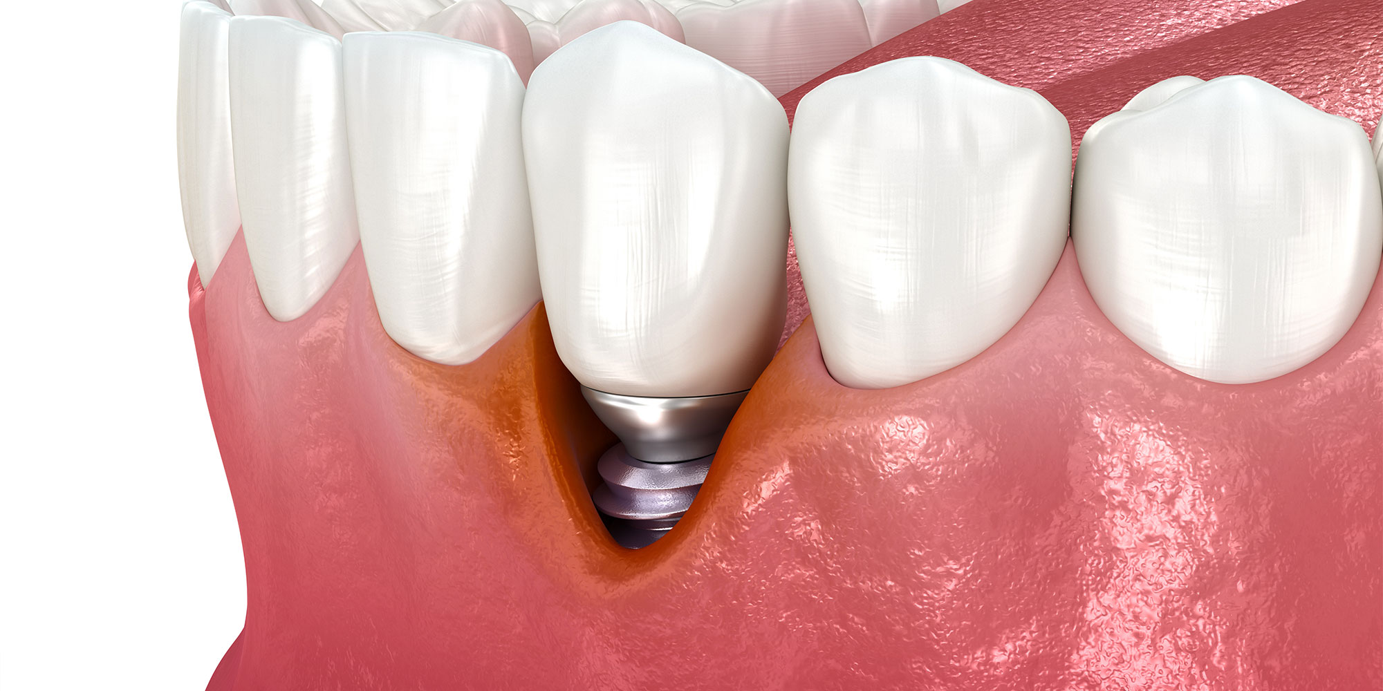 Failing dental implants