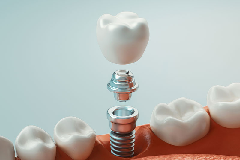 Dental Implants