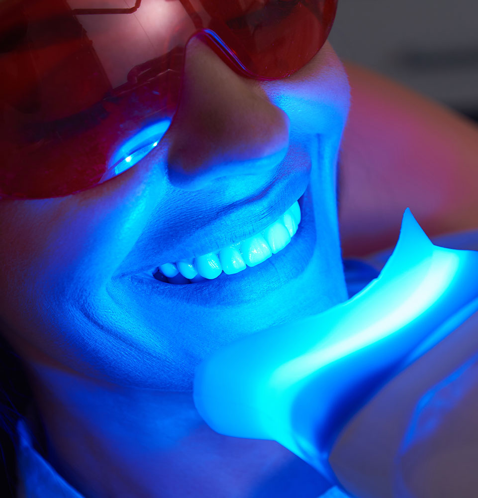 teeth whitening