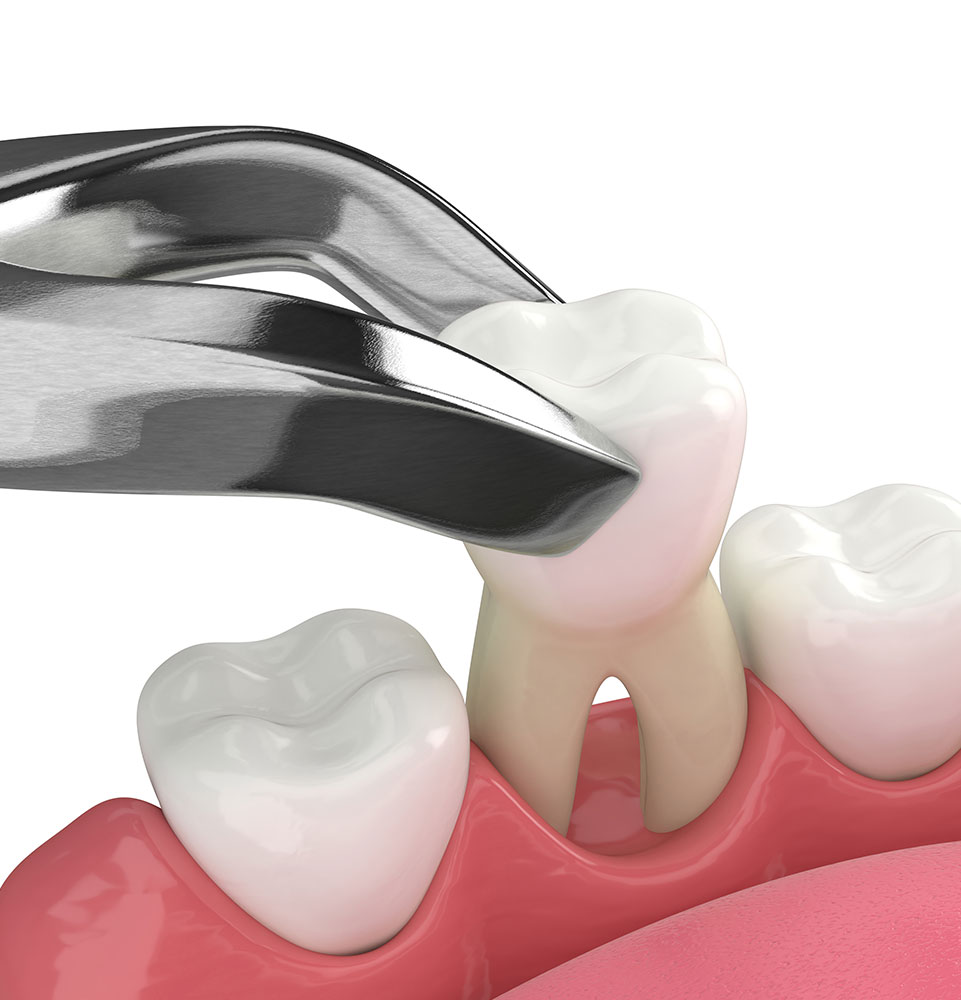 tooth extraction