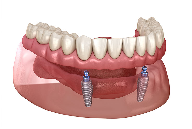 Supported dentures