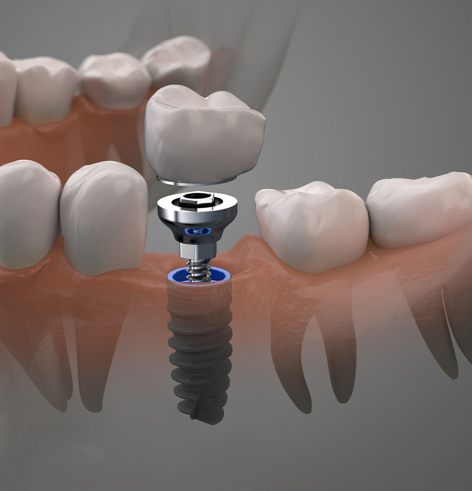 dental implants