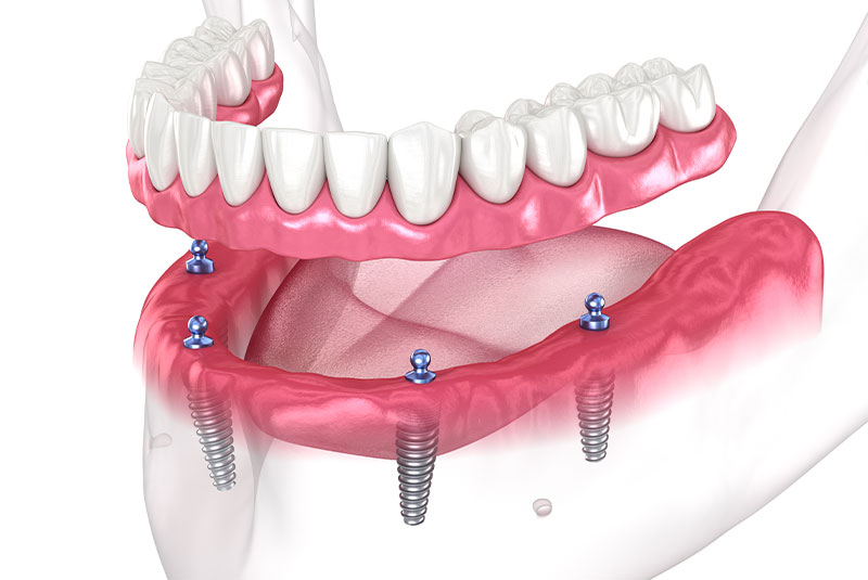 Full arch dental implants