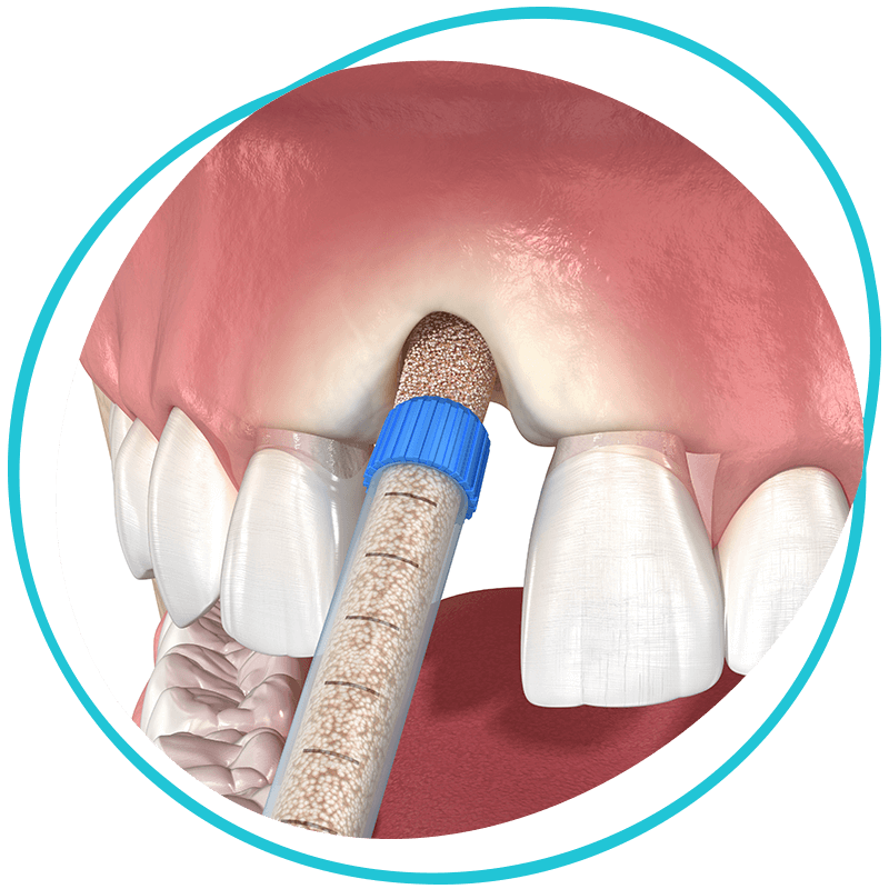 Bone grafting