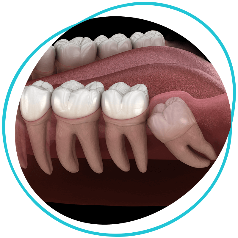 Wisdom teeth