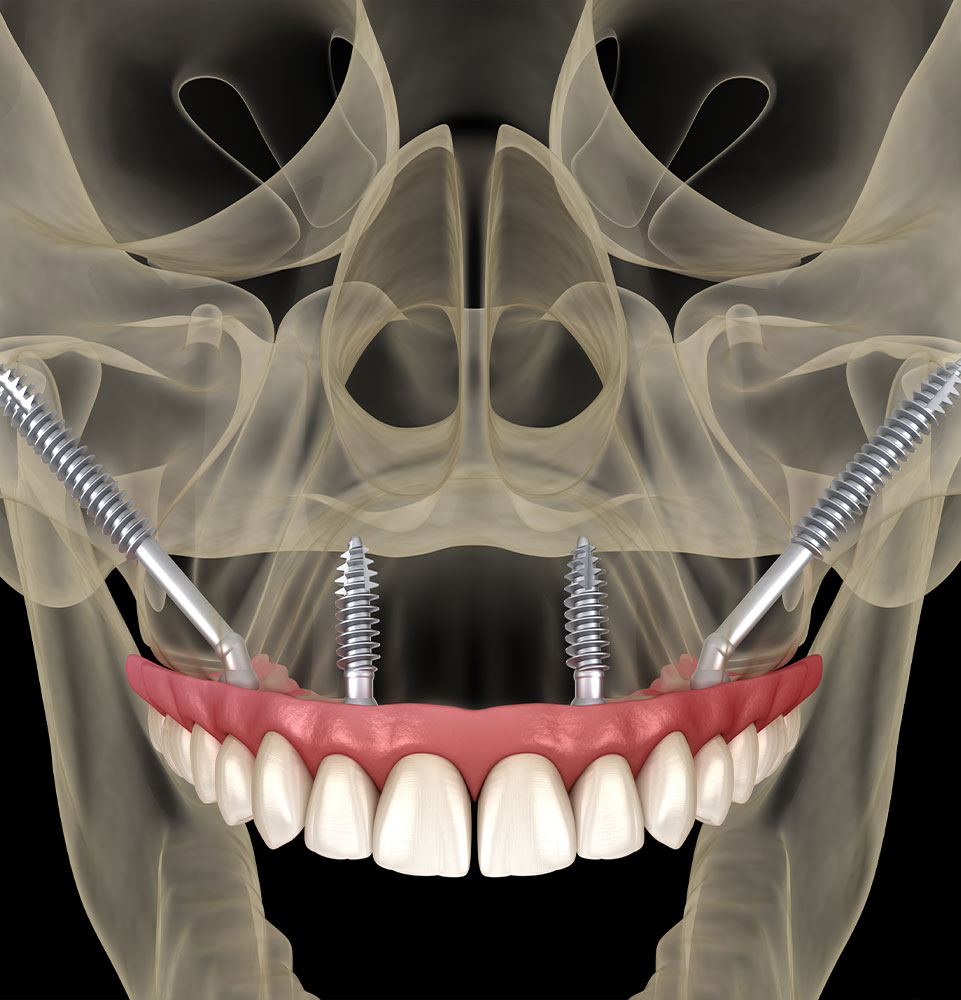zygo dental implants