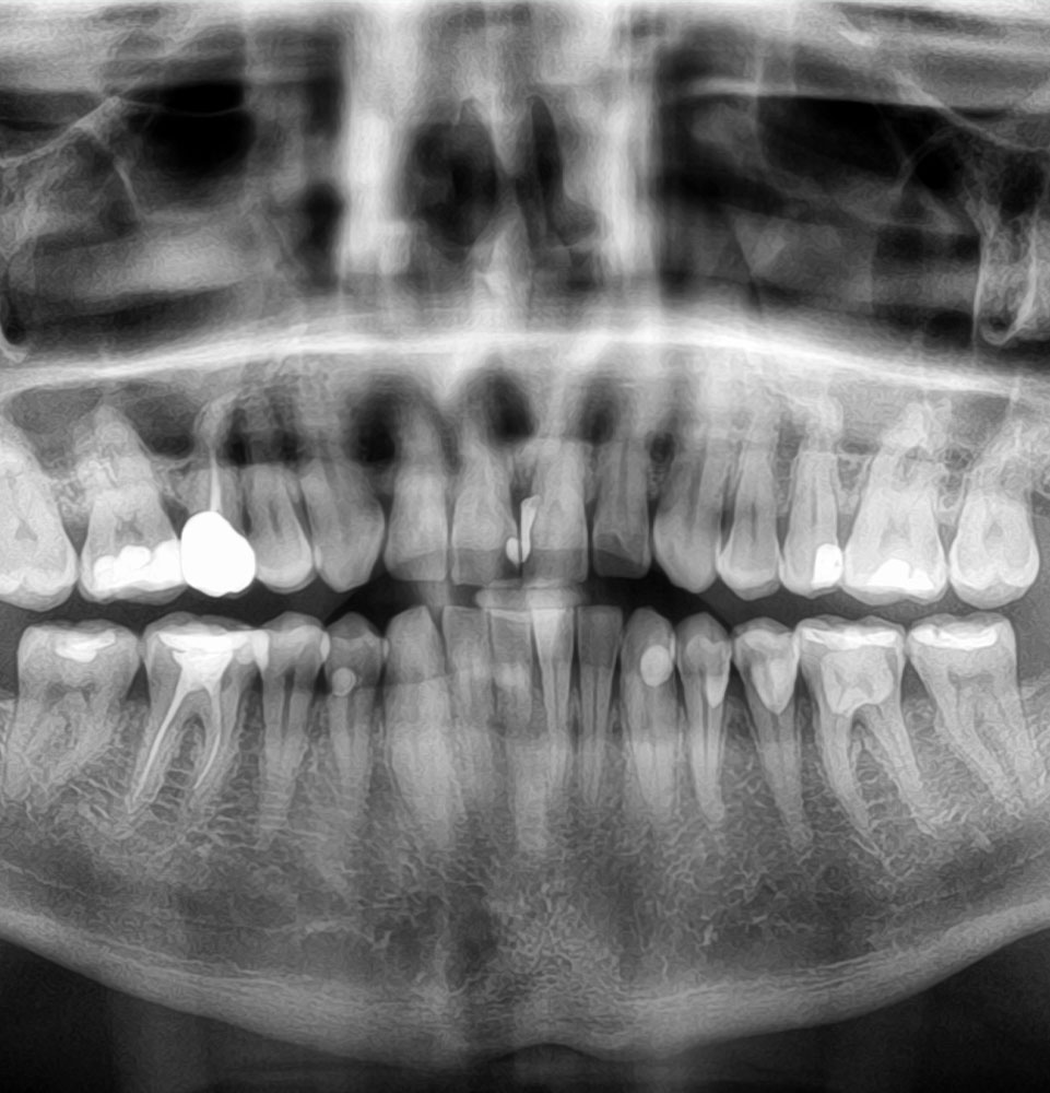 dental x-ray