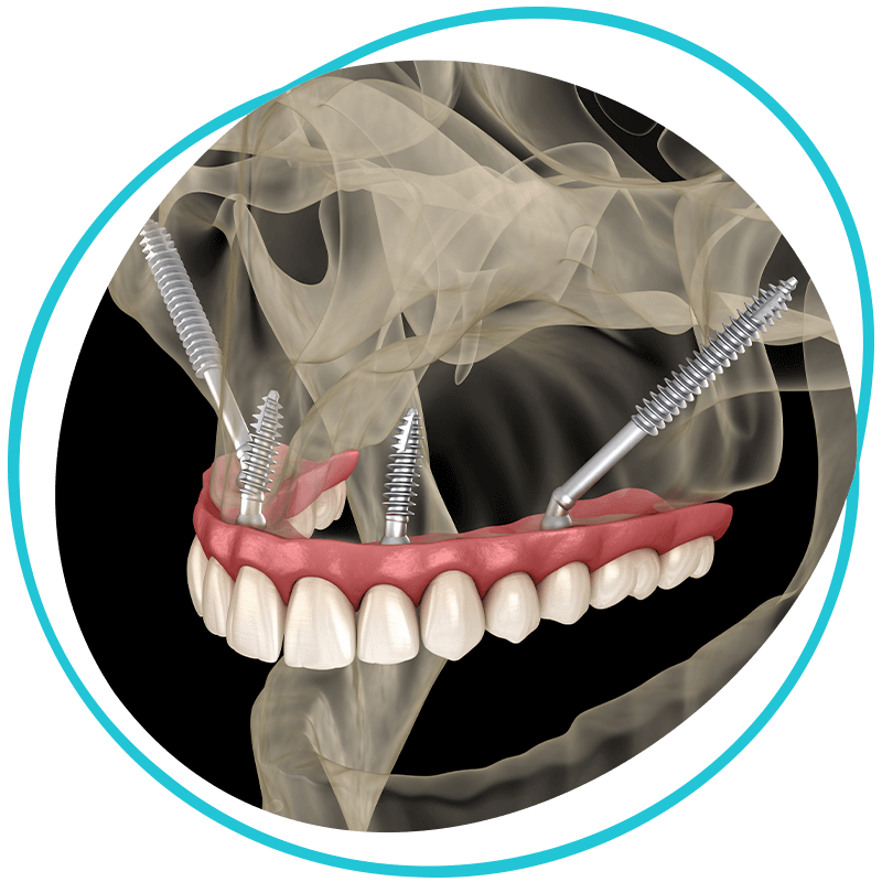 Zygomatic Implants