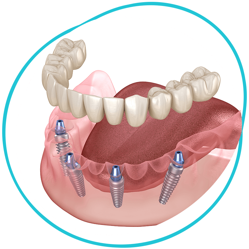 full arch dental implants