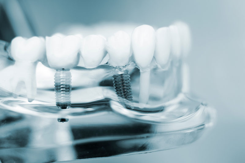 Dental implant Bridge