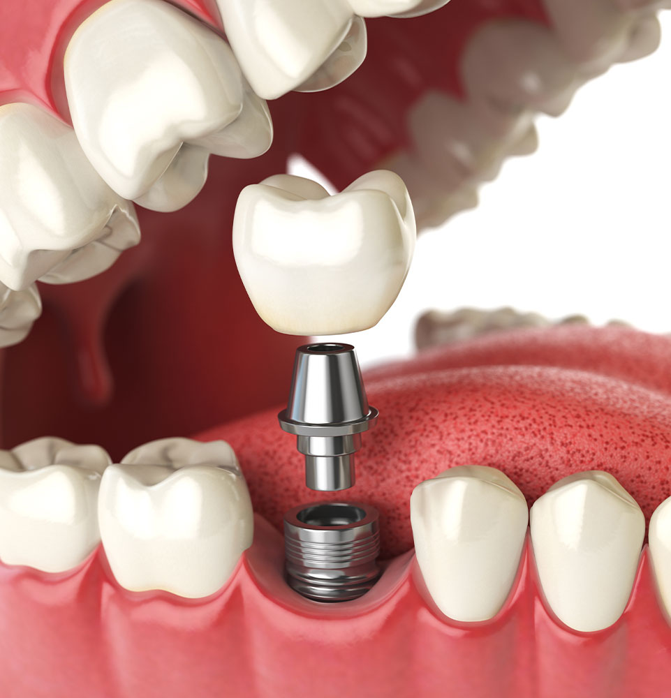 dental implant