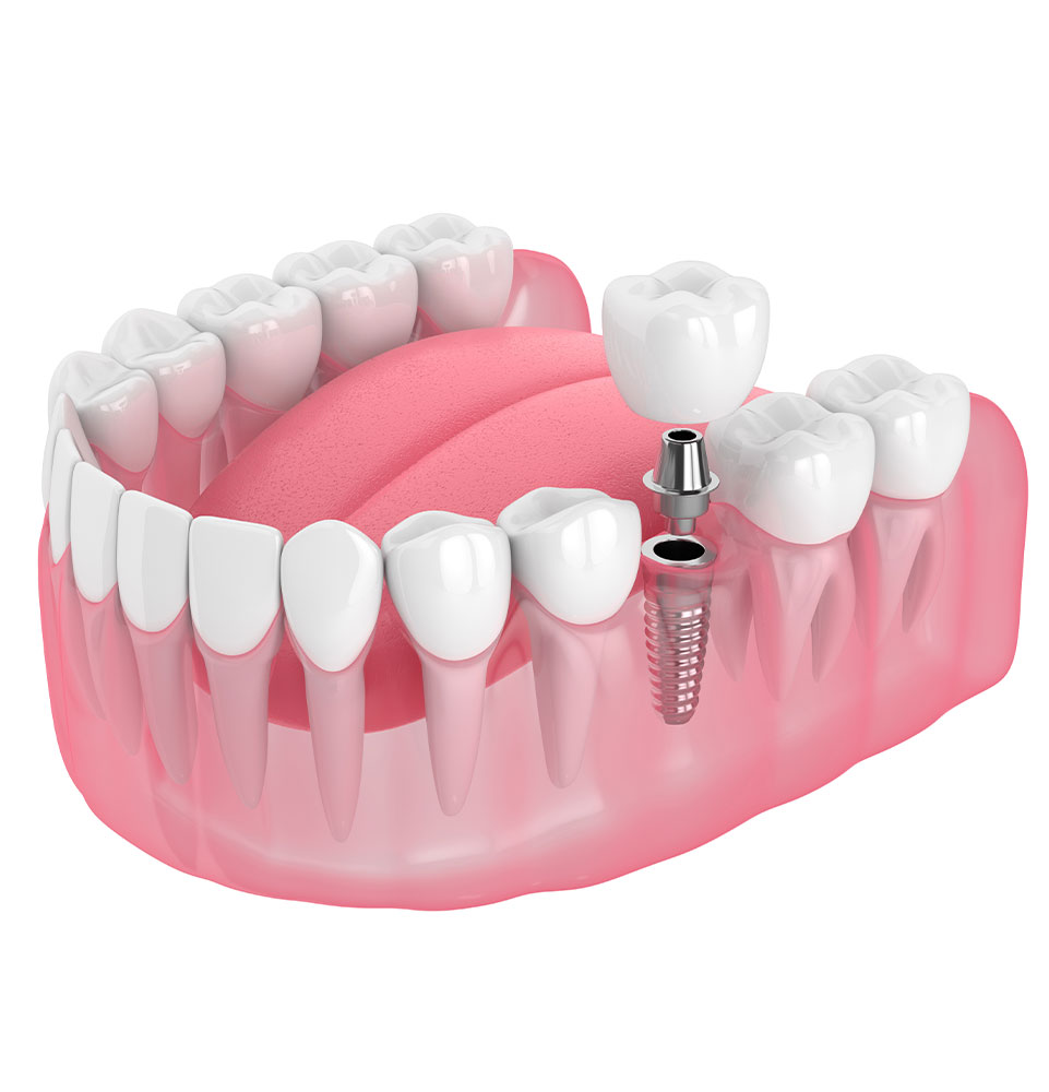 Dental implants